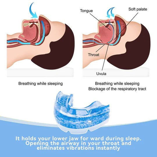 AureaGuard | Customizable Anti-Snoring Mouthpiece for Restful Sleep
