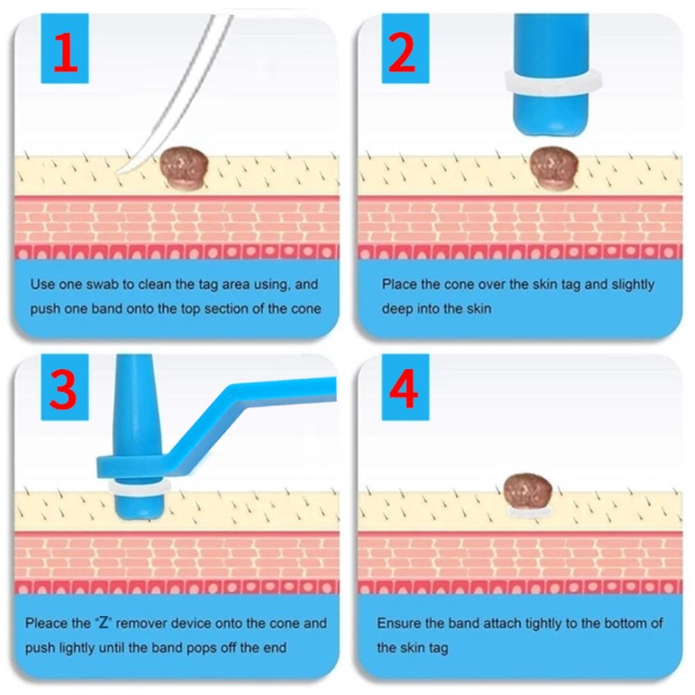 2-in-1 Silicone Band Skin Tag Removal Kit for Home Use – Precision At-Home Care Tool for Targeted Skin Treatment