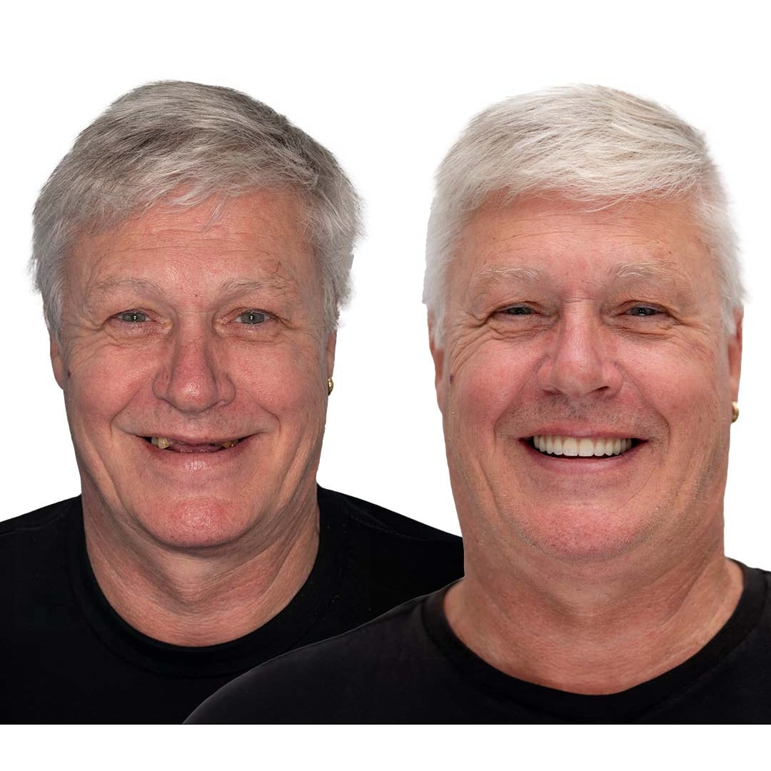 Men's Affordable Dental Implants and Dentures with Flexible Cushion Grip and Storage Case - Image 11