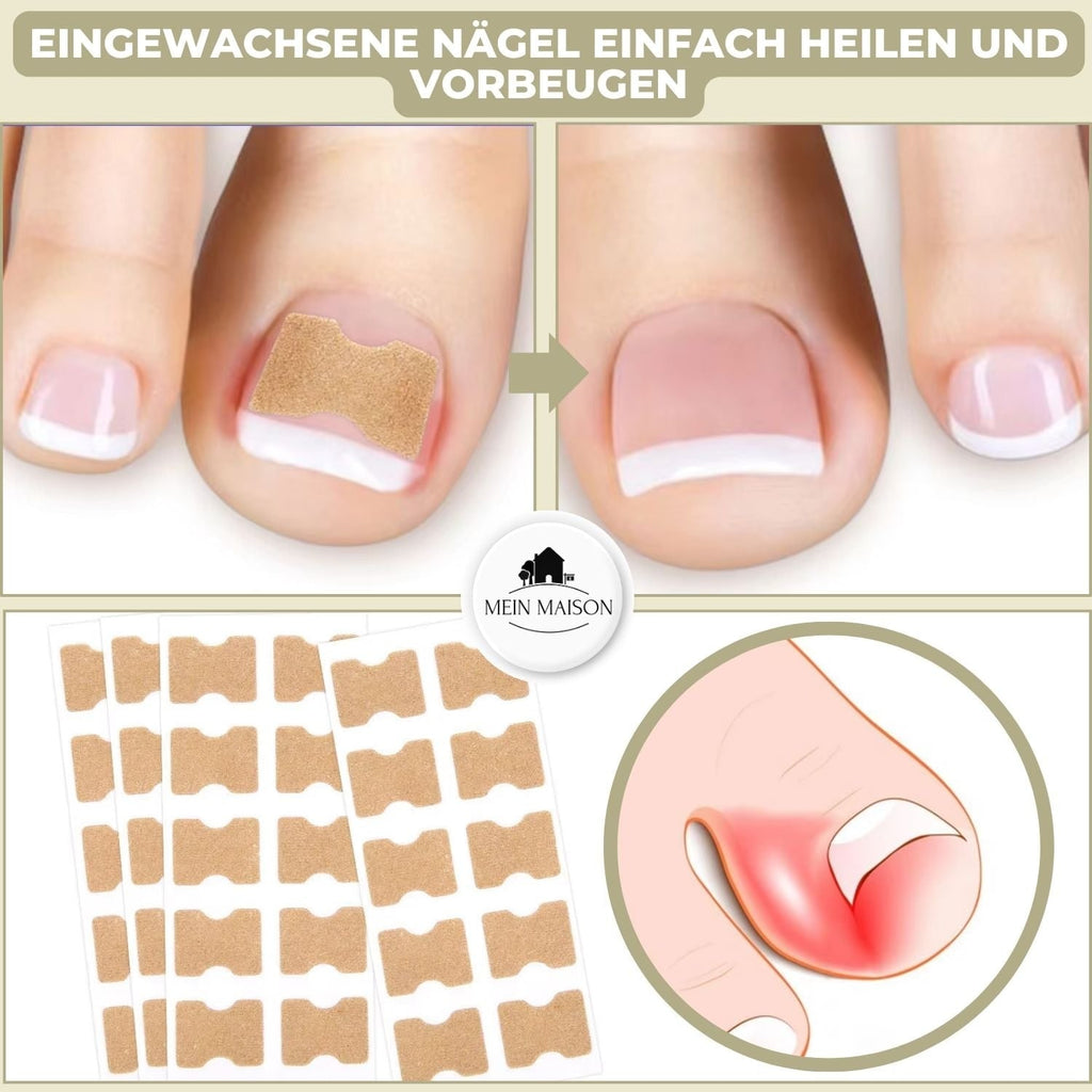 Men's Ingrown Nail Treatment Corrector Patches with Adhesive Peel and Stick Application - Image 2