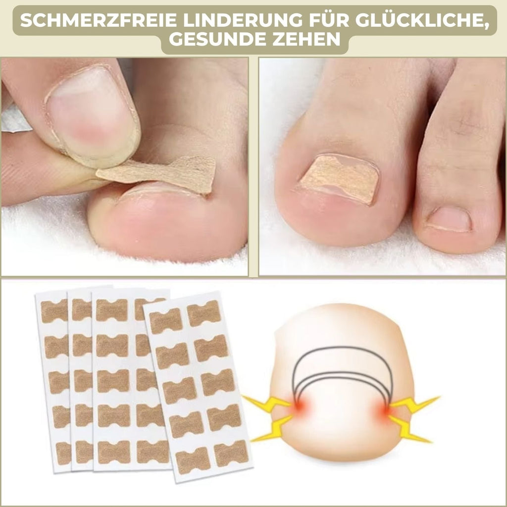 Men's Ingrown Nail Treatment Corrector Patches with Adhesive Peel and Stick Application - Image 3