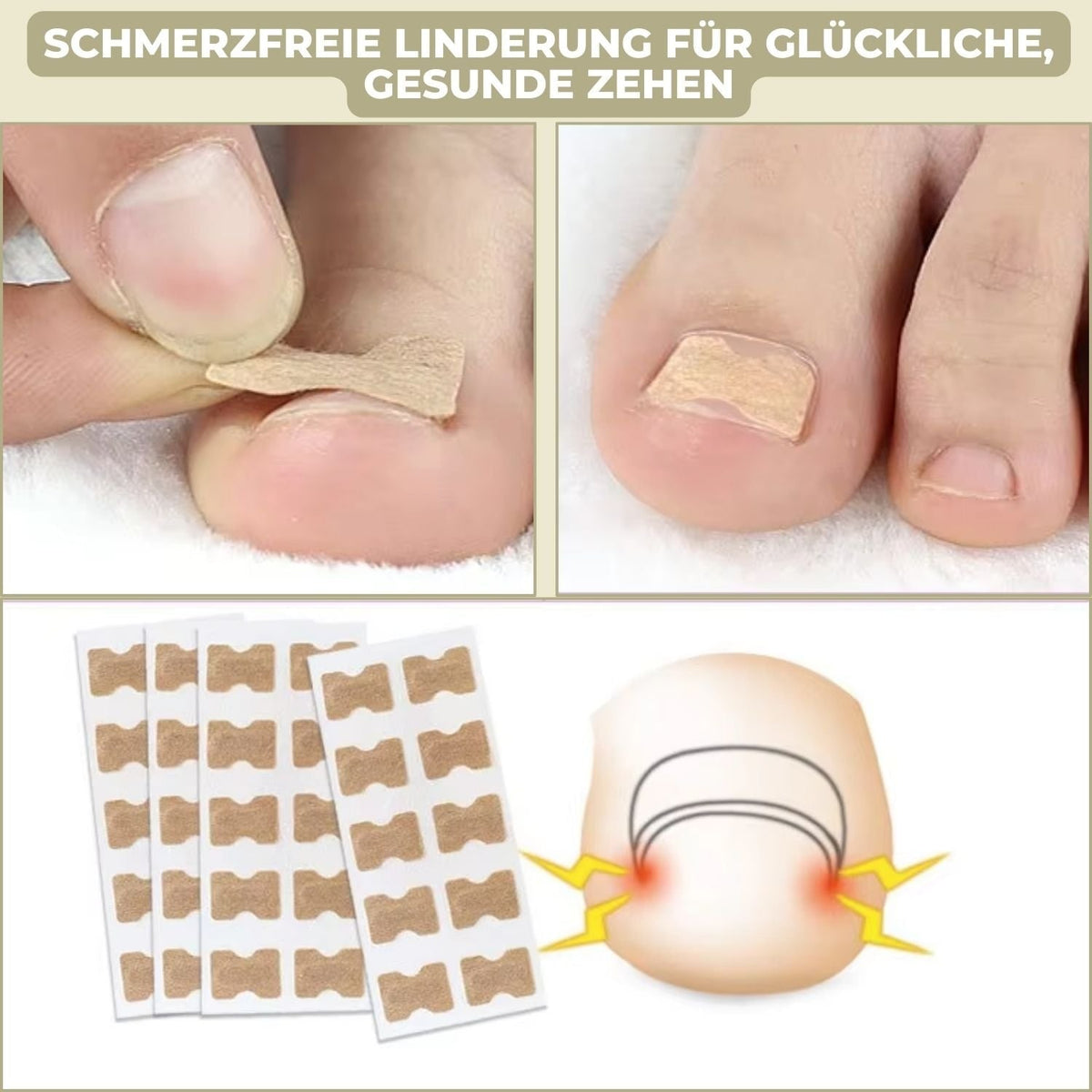 Men's Ingrown Nail Treatment Corrector Patches with Adhesive Peel and Stick Application - Image 3