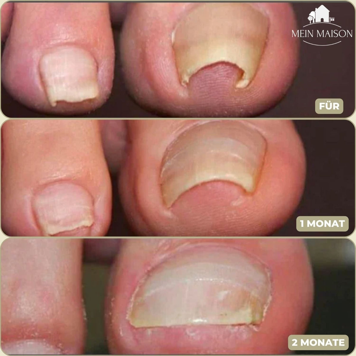 Men's Ingrown Nail Treatment Corrector Patches with Adhesive Peel and Stick Application - Image 4