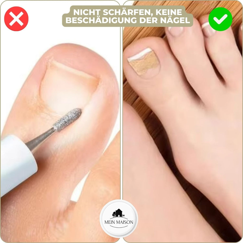 Men's Ingrown Nail Treatment Corrector Patches with Adhesive Peel and Stick Application - Image 5