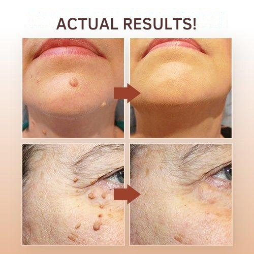 Skin Tag Remover Brush Removal Tool Targeted Treatment Pen Applicator Natural Wart - Image 2