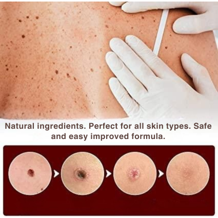 Skin Tag Remover Brush Removal Tool Targeted Treatment Pen Applicator Natural Wart - Image 3