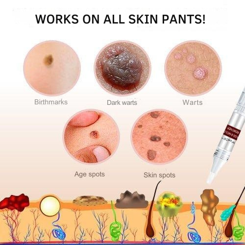 Skin Tag Remover Brush Removal Tool Targeted Treatment Pen Applicator Natural Wart - Image 5