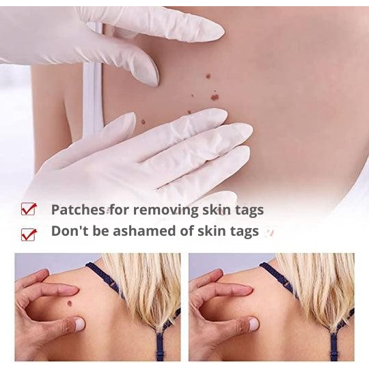 Skin Tag Remover Brush Removal Tool Targeted Treatment Pen Applicator Natural Wart - Image 6
