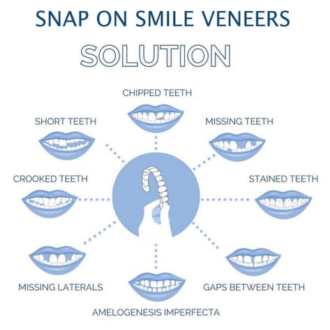 Snap on Veneers Temporary Smile Cosmetic Dental Flexible Removable Upper Lower - Image 6