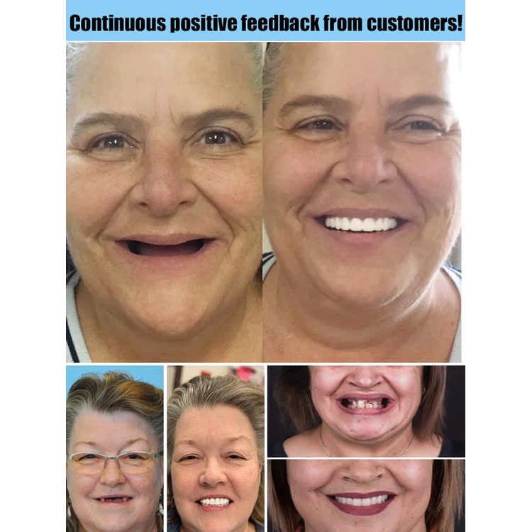 Snap on Veneers with Moldable False Teeth for Upper and Lower Jaw Reusable Cosmetic - Image 5