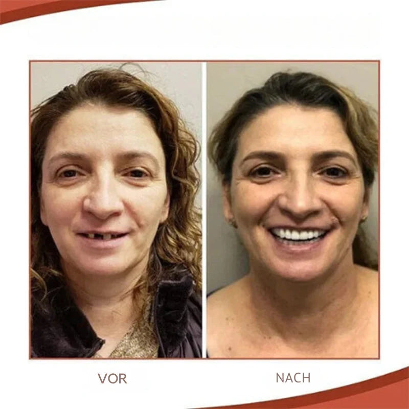 Snap on Veneers with Moldable Thermal Beads and Cosmetic False Teeth Kit - Image 5