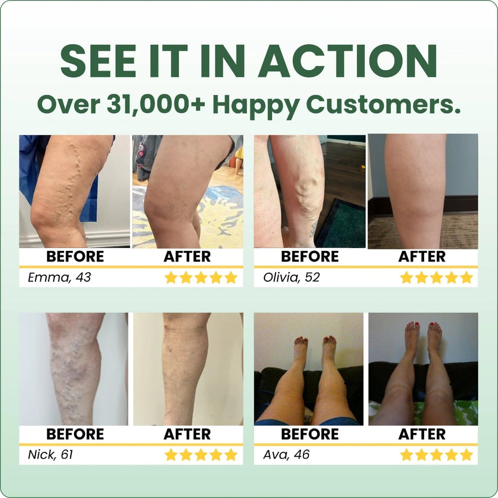 Varicose Vein with Horse Chestnut Arnica Calendula Balm - Image 13