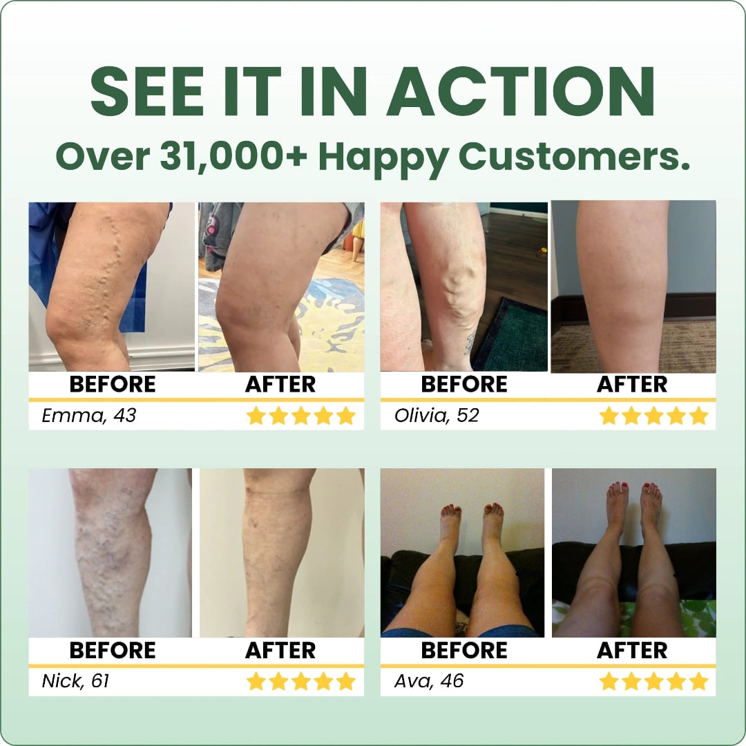 Varicose Vein with Horse Chestnut Arnica Calendula Balm - Image 13