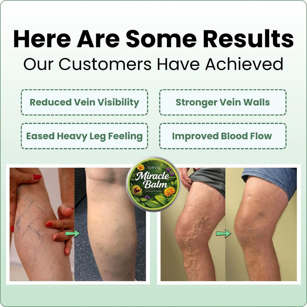 Varicose Vein with Horse Chestnut Arnica Calendula Balm - Image 5